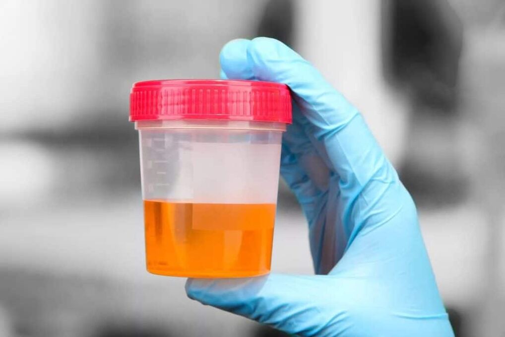 Urine with blood during calculous prostatitis